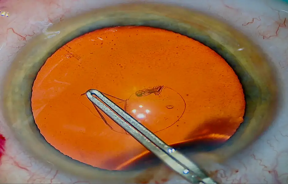 cataract 9 copy