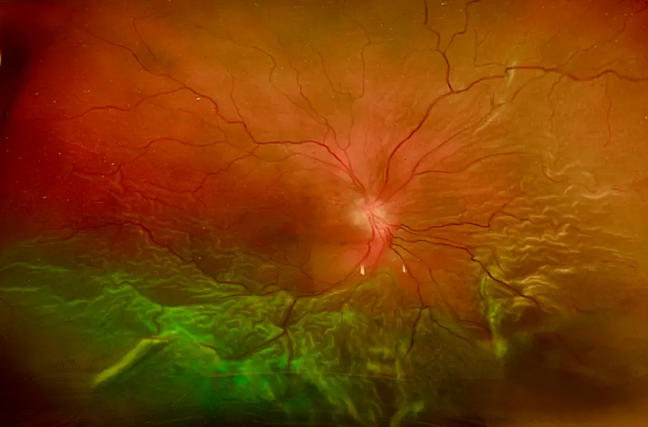 retinal detachment 1